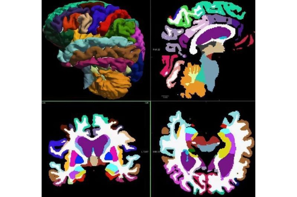 MRI ээр Альцгеймерыг AI гаар түрүүн үед нь тодорхойлох